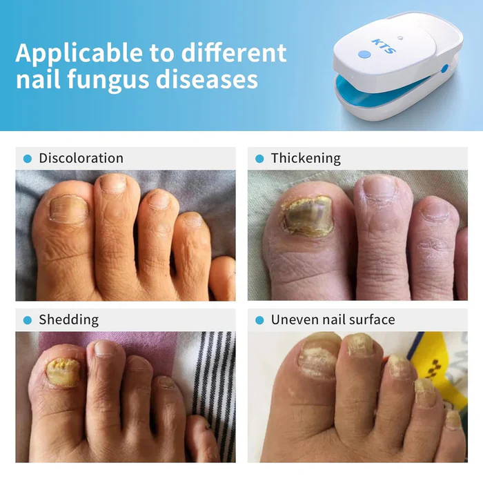 KTS® Nail Fungus Laser Treatment Device Collection - Image 11