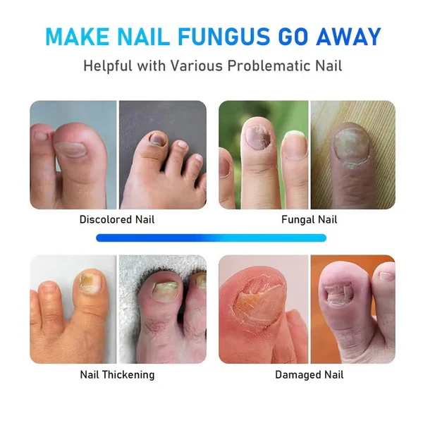 KTS® New Onychomycosis Laser Treatment Device - Image 3