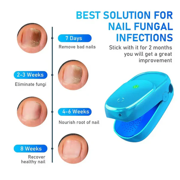 KTS® New Onychomycosis Laser Treatment Device - Image 4